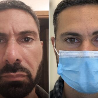 Prima-dopo-Hunter-eyes-estetica-uomo