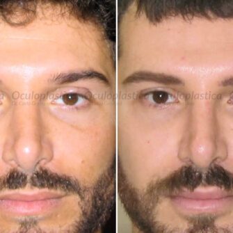 Prima-dopo-Hunter-eyes-intervento-chirurgico-estetica-uomo