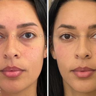 Prima-dopo-filler-orbita-inferioreper-cerchi-scuri-occhiaie