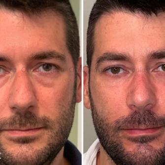 Prima dopo Eye Define Lyft blefaroplastica inferiore con riposizionamento del grasso