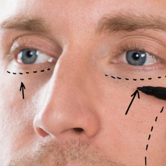 Riposizionamento-grasso-palpebra-blefaroplastica-inferiore