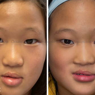 Prima-dopo-correzione-epiblefaron-pediatrico