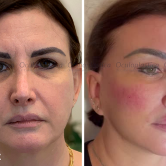 Prima dopo filler palpebre viso medio labbra fullface