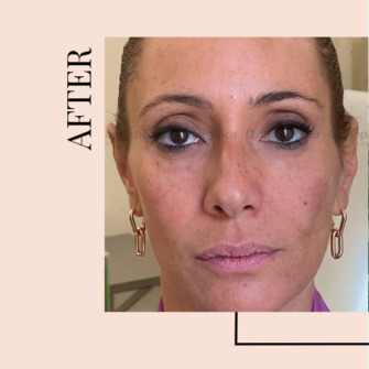 Dopo-filler-acido-ialuronico-borse-occhiaie