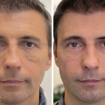 Prima-Dopo-complicanza-filler-acido-ialuronico-ialuronidasi-uomo