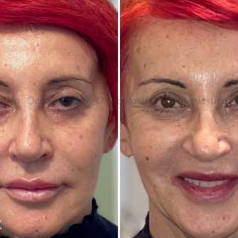 Prima-dopo-blefaroplastica-superiore-correzione-ptosi-filler-acido-ialuronico-tempie