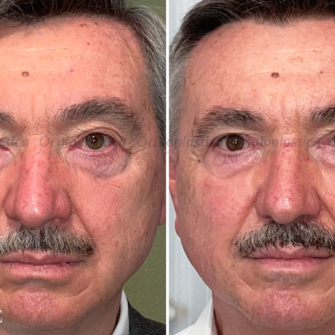 Prima-dopo-blefaroplastica+correzione-ptosi-uomo