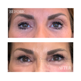 Prima-dopo-botulino-funzionale-post-paralisi-facciale