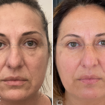 Prima-dopo-complicanza-chirurgica-blefaroplastica