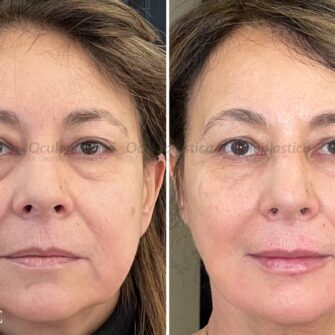 Prima-dopo-filler-acido-ialuronico-borse-linea-mandibolare