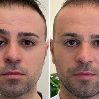 Prima-dopo-ptosi-congenita-uomo