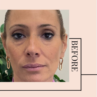 Prima-filler-acido-ialuronico-borse-occhiaie