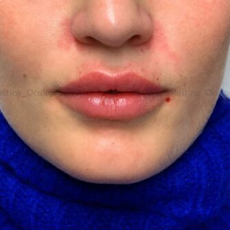 filler-acido-ialuronico-labbra