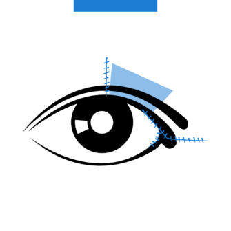 intervento-correzione-ptosi-congenita