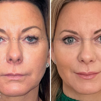 Prima dopo blefaroplastica superiore ptosi