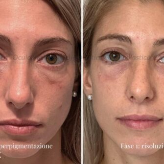 Prima dopo complicanza filler