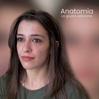 Dopo filler occhiaie fillerorbita3d