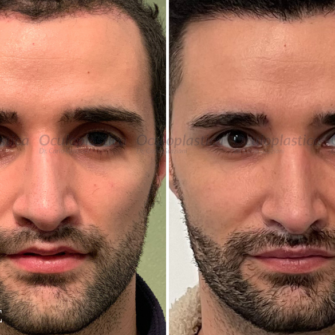 Prima dopo ptosi palpebrale hunter eyes uomo