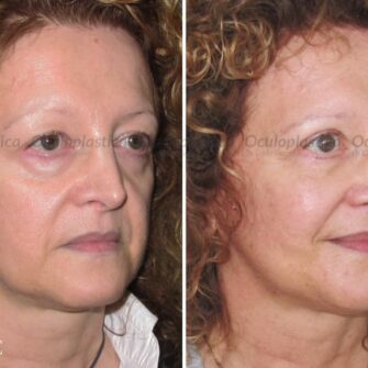 Prima e dopo blefaroplastica inferiore superiore e lipofilling