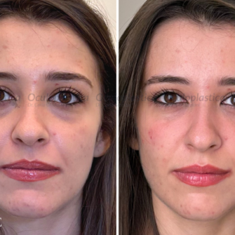 Prima dopo filler occhiaie fillerorbita3d