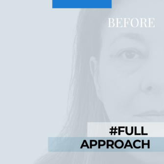 Prima Filler acido ialuronico occhi viso e linea mandibolare