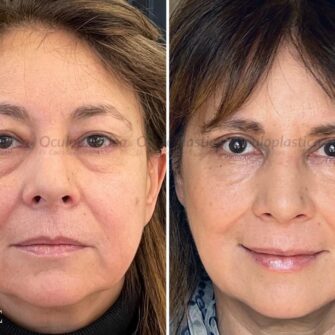 Prima dopo Filler acido ialuronico occhi viso e linea mandibolare blefaroplastica ptosi palpebrale
