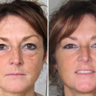 Prima dopo filler acido ialuronico borse sotto gli occhi