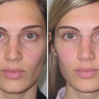 Prima dopo filler occhiaie fillerorbita3d