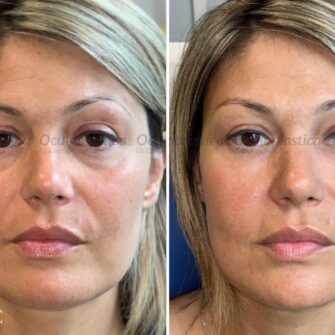 Prima dopo filler orbita 3d acido ialuronico occhiaie