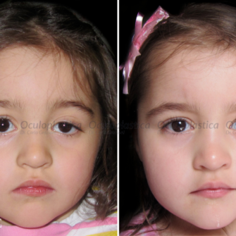 Prima dopo ptosi palpebrale congenita pediatrica