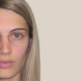 Dopo filler occhiaie fillerorbita3d