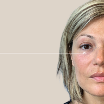 filler orbita 3d acido ialuronico occhiaie