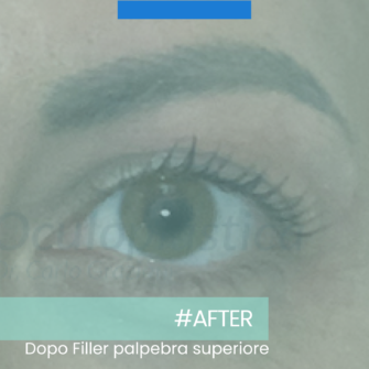 Dopo filler palpebra superiore Dopo filler palpebra superiore
