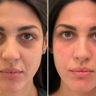 Prima dopo filler palpebre fillerorbita3d occhiaie borse sotto gli occhi Prima dopo filler palpebre fillerorbita3d occhiaie borse sotto gli occhi