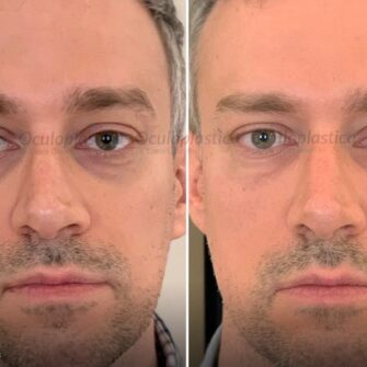 Prima dopo filler palpebre fillerorbita3d occhiaie borse sotto gli occhi uomo Prima dopo filler palpebre fillerorbita3d occhiaie borse sotto gli occhi uomo