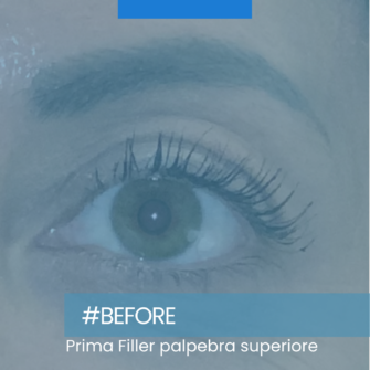Prima filler palpebra superiore Prima filler palpebra superiore