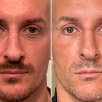 Prima dopo EyeDefine Lyft Blefaroplastica inferiore transcongiuntivale lipofilling Prima dopo EyeDefine Lyft Blefaroplastica inferiore transcongiuntivale lipofilling