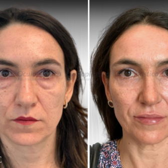 Prima dopo EyeDefine Lyft Blefaroplastica borse sotto gli occhi cantopessi Prima dopo EyeDefine Lyft Blefaroplastica borse sotto gli occhi cantopessi