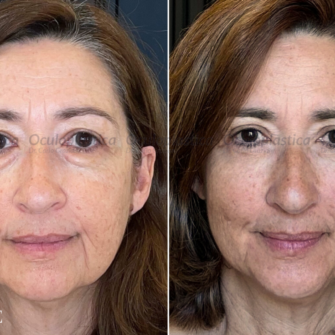Prima dopo EyeDefine Lyft Blefaroplastica inferiore cantoplastica lipofilling Prima dopo EyeDefine Lyft Blefaroplastica inferiore cantoplastica lipofilling
