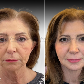 Prima Dopo EyeDefine Lyft Lipofilling Cantoplastica Lifting Malare Blefaroplastica Superiore 2.0 Ptosi palpebrale Prima Dopo EyeDefine Lyft Lipofilling Cantoplastica Lifting Malare Blefaroplastica Superiore 2.0 Ptosi palpebrale