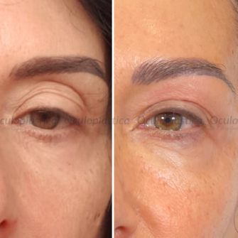 Prima Dopo Filler Palpebra Superiore Prima Dopo Filler Palpebra Superiore