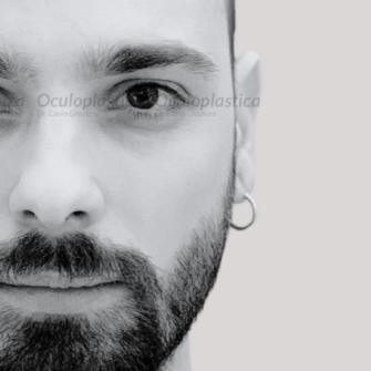 Dopo filler palpebra superiore uomo hunter eyes Dopo filler palpebra superiore uomo hunter eyes