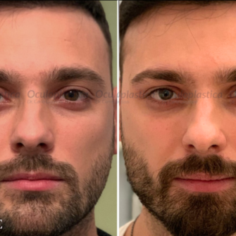 Prima dopo Filler palpebra superiore uomo hunter eyes Prima dopo Filler palpebra superiore uomo hunter eyes