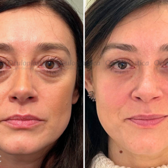 Prima dopo filler palpebra superiore filler orbita 3b borse sotto gli occhi Prima dopo filler palpebra superiore filler orbita 3b borse sotto gli occhi