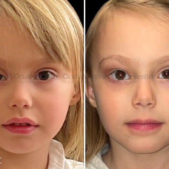 Prima dopo ptosi congenita pediatrica