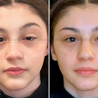 Prima dopo ptosi congenita pediatrica Marcus Gunn