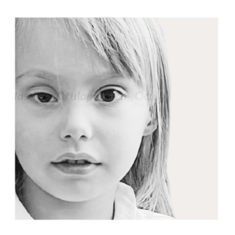 Prima ptosi congenita pediatrica