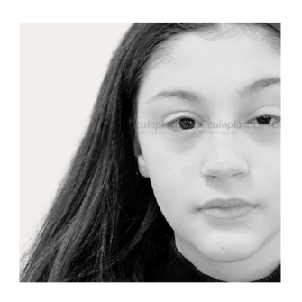 Prima ptosi congenita pediatrica marcus gunn