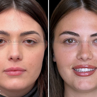 Prima dopo Ptosi palpebrale Blefaroplastica superiore 2.0