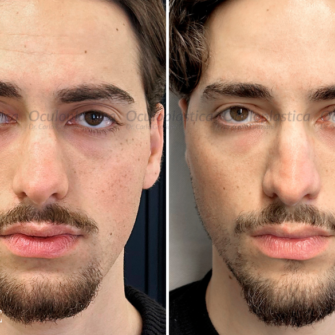 Prima dopo ptosi palpebrale asimmetria sguardo.